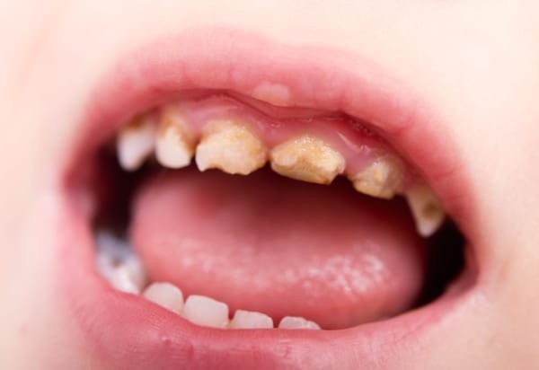 Tác hại của sâu răng trẻ em